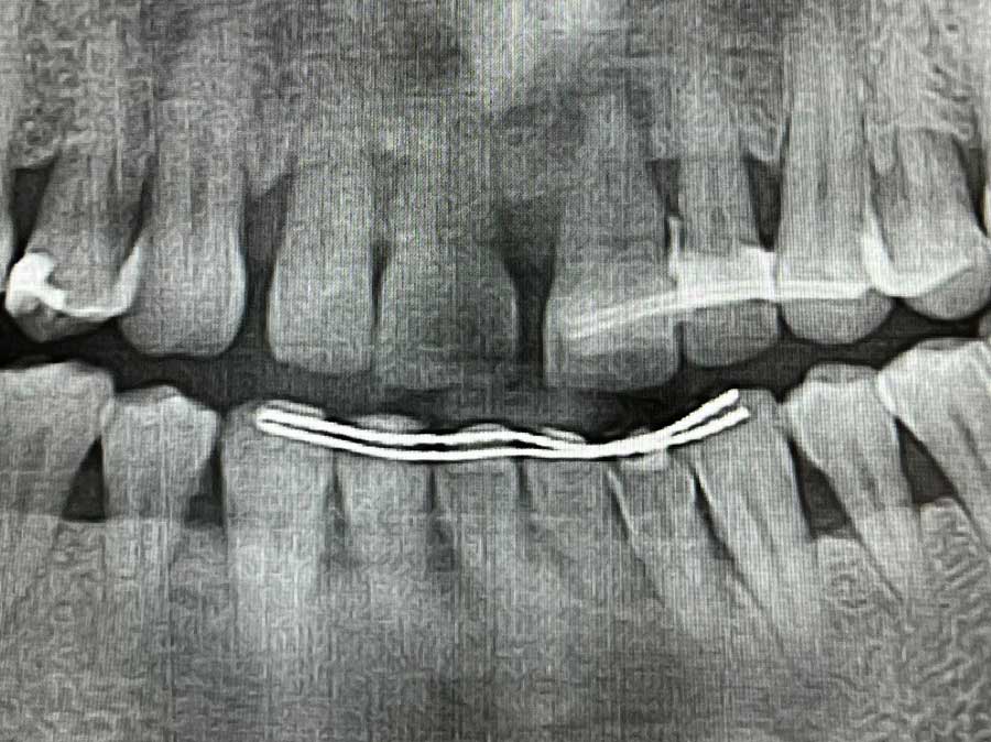 Caso clínico 10: Caso de Jordi Implantes dentales