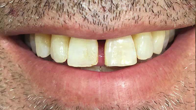 Caso clínico 10: Caso de Jordi Implantes dentales