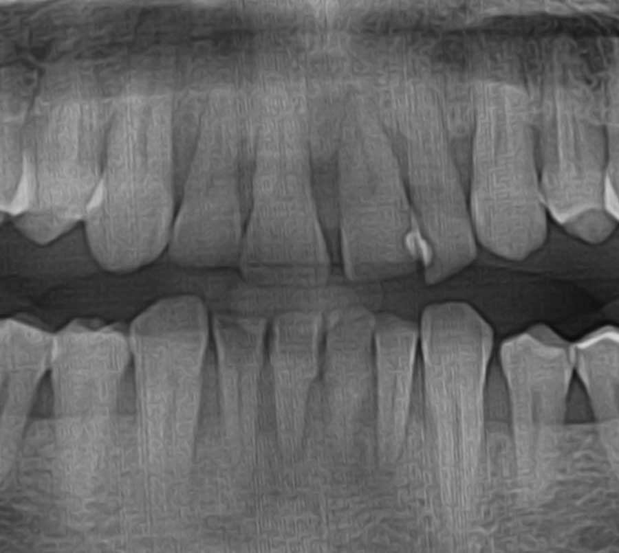 Caso clínico 9: Caso de Jose Maria Implantes dentales