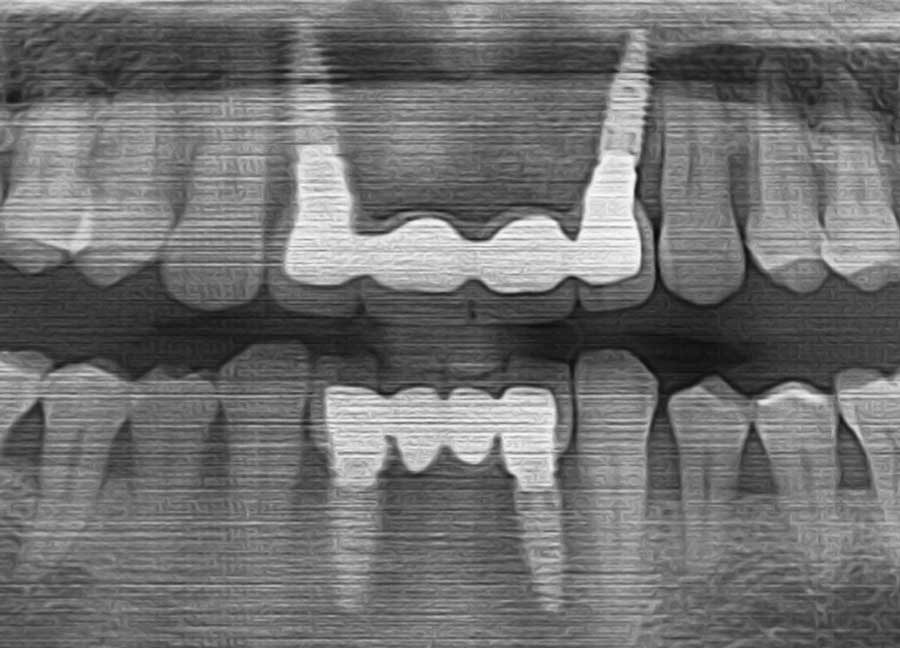 Caso clínico 9: Caso de Jose Maria Implantes dentales