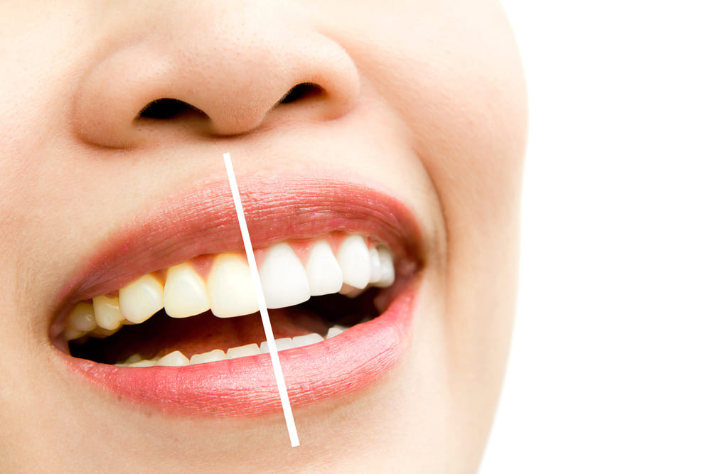 mujer-en-un-tratamiento-blanqueador blanqueamiento dental