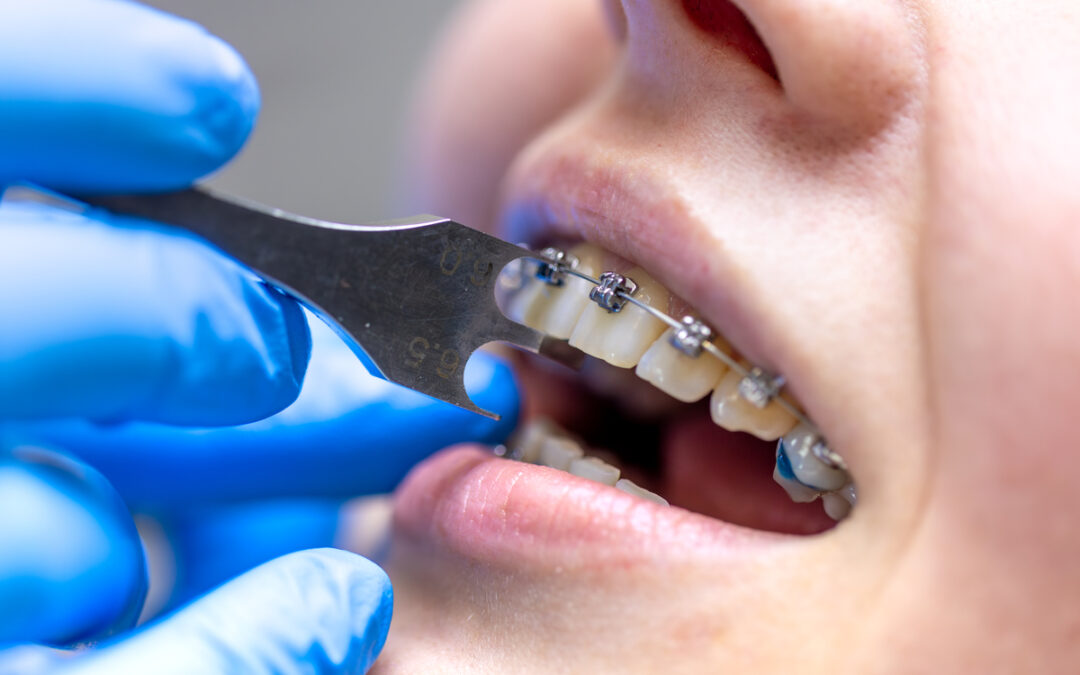 ¿Cuánto dura el tratamiento de ortodoncia? Guía clara con tiempos reales