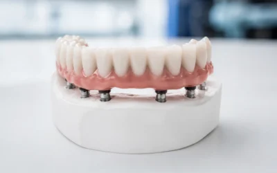 Prótesis fija sobre implantes o sobredentadura: diferencias y cuál elegir